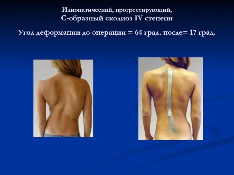 Сколиоз прогрессирует. Идиопатический s образный сколиоз. с образный сколиоз 4 степени. s образное искривление позвоночника. сколиоз 2 степени s образный идиопатический.