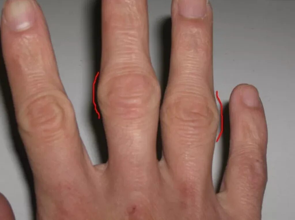 Болит сустав у основания большого пальца руки. Ревматоидные узелки Гебердена.