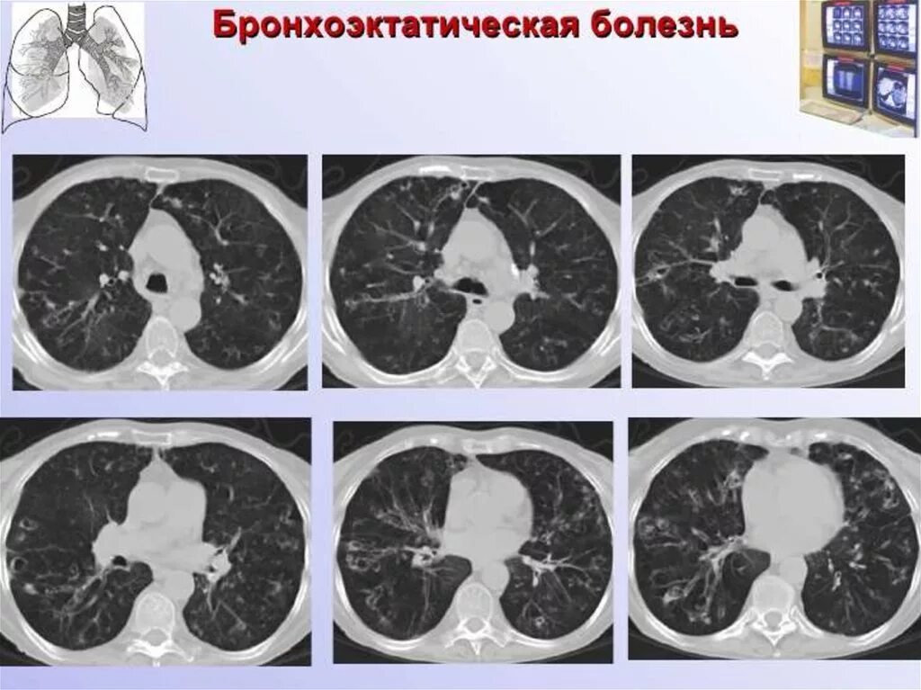 Кт 4 легкие. Снимок кт легких здорового человека. Кт легких норма. Кт легких снимки здорового. Кт здоровых легких.