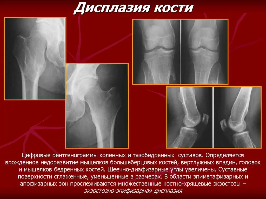 Наличия дисплазии. Полиоссальная фиброзная дисплазия бедренной кости. Эпифизарная дисплазия коленного сустава рентген. Фиброзно хрящевая дисплазия большеберцовой кости. Эпифизарная дисплазия бедренной кости.