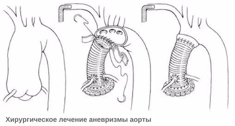 Аневризма восходящей аорты операция. Супракоронарное протезирование восходящего отдела аорты. Операция Дэвида аневризма восходящей аорты. Аневризма восходящего отдела грудной аорты.