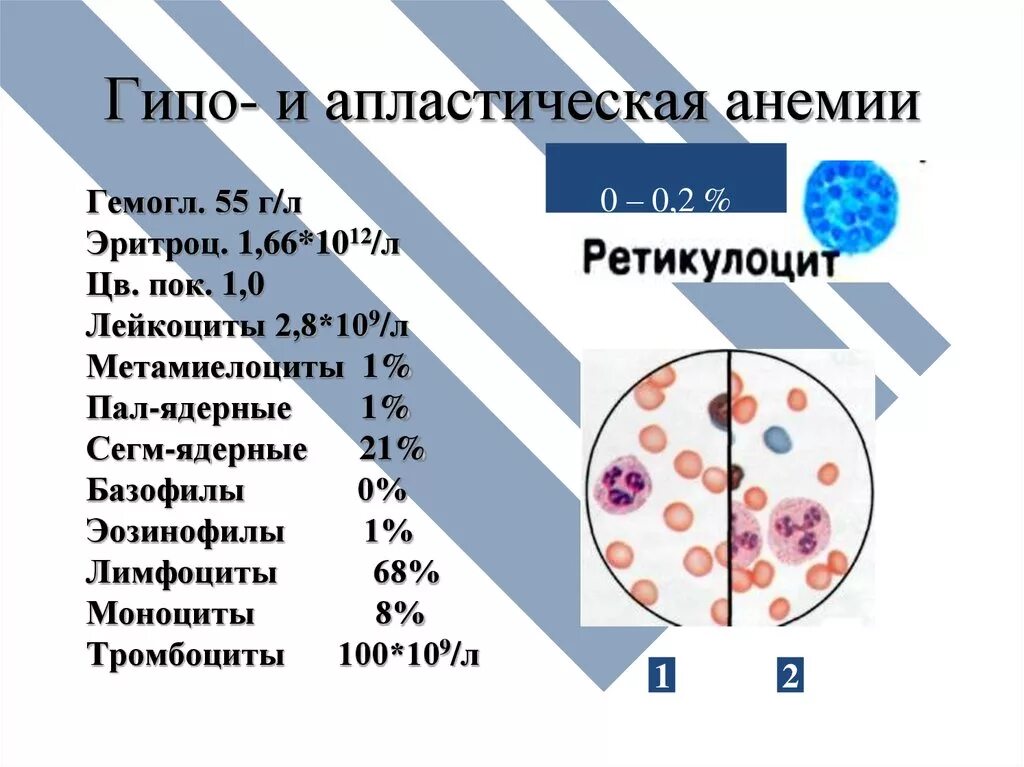 Показатели анемии в анализе. Гипопластическая анемия анализ крови показатели. Анализ крови при гипопластической анемии. Общий анализ крови при гипопластической анемии. Лейкоформула при апластической анемии.