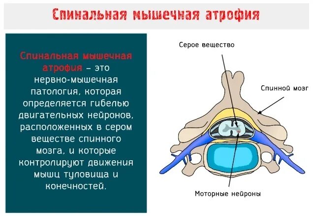 Сма мозга. Проксимальная спинальная мышечная атрофия. Спинальная мышечная атрофия этиология. Спиная мышкчная атроыия. Проксимальная спинальная амиотрофия.