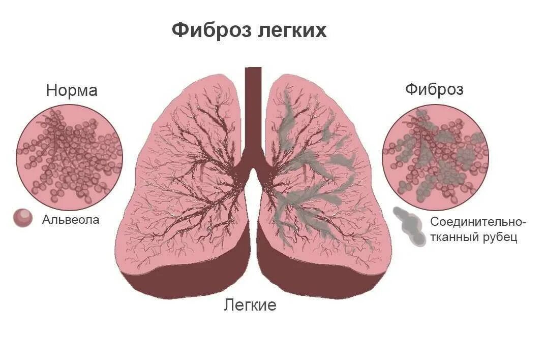 Линейный пневмофиброз