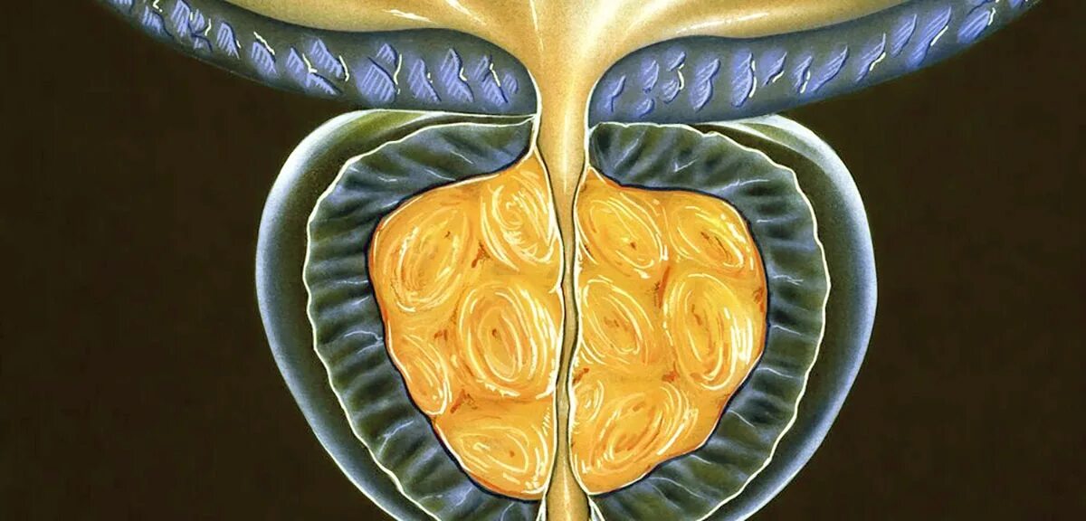 Гонококковое поражение предстательной железы. Аденома простаты анатомия. Анатомия аденомы предстательной железы. Воспаленная предстательная железа. Первые признаки предстательной железы