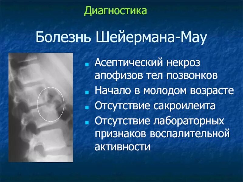 Болезнь шейермана мау что это такое. Асептический некроз тел позвонков. Остеохондропатия апофиза позвонка. Асептический некроз позвонка рентген.