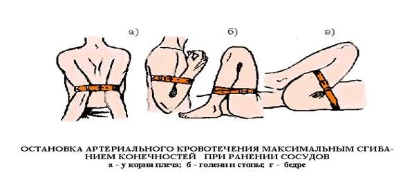Остановка артериального кровотечения алгоритм. Кровотечения прижатие артерий. Остановка кровотечения прижатием. Остановка артериального кровотечения пальцевым прижатием.