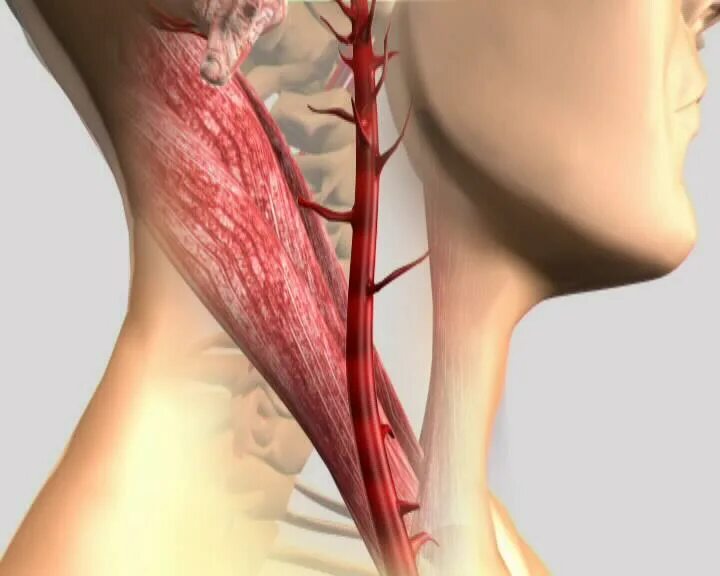 Операция каротидная эндартерэктомия. Бляшка на шее операция