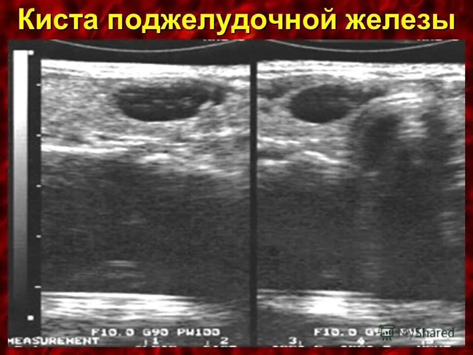 гигрома лучезапястного сустава мкб 10. сто киа. в кисте есть жидкость. в кисте есть жидкость. в кисте есть жидкость.