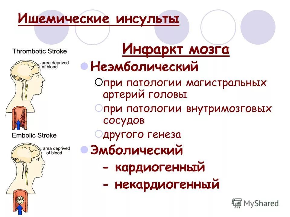 Чем отличается инфаркт от инсульта простыми. Классификация ишемического инсульта. Ишемический инсульт (инфаркт мозга). Презентация на тему инсульт.