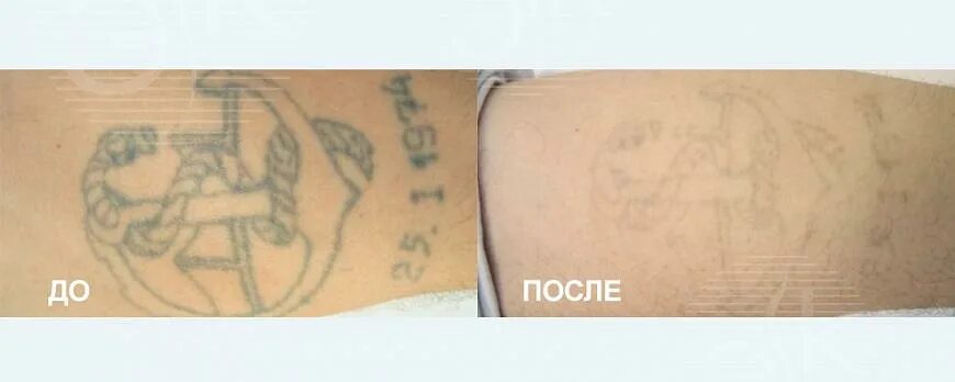 Можно ли в бассейн после тату. Шрамы после удаления татуировки. удаление тату надписи до и после. удаление татуировки лазером до и после.
