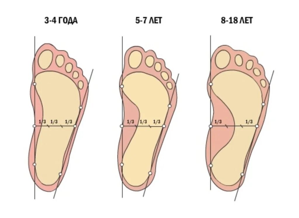 Быстро растет стопа. Лечится ли плоскостопие у детей 6 лет. Плоскостопие 1.6 у ребенка. Плоскостопие 1 степени у детей 3 лет. Стопы детей с плоскостопием.