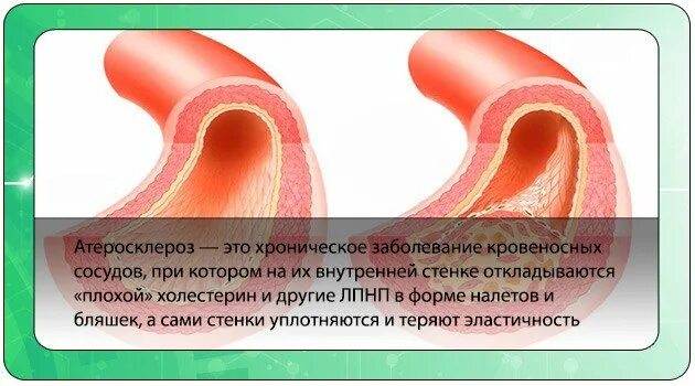 Продукты очищающие сосуды от холестерина. Препараты для очистки сосудов от холестериновых бляшек. для очищения сосудов препараты от холестериновых бляшек. чистка сосудов от атеросклероза. чистка сосудов холестерина.