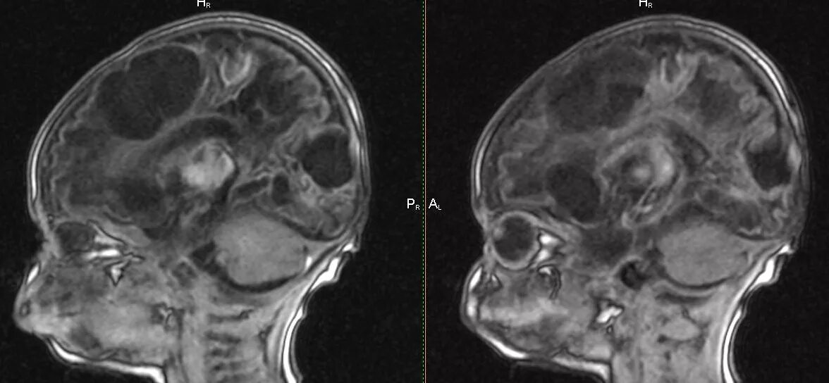 Последствия гидроцефалии головного мозга. Нормотензивная гидроцефалия мрт. Гидроцефалия головного мозга мрт. Гидроцефалия головного мозга у ребенка мрт.