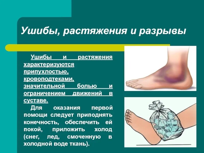 Как понять вывих или растяжение. Таблица первая помощь растяжения ушиб перелом. ушиб и растяжение связок. признаки ушиба и растяжения.