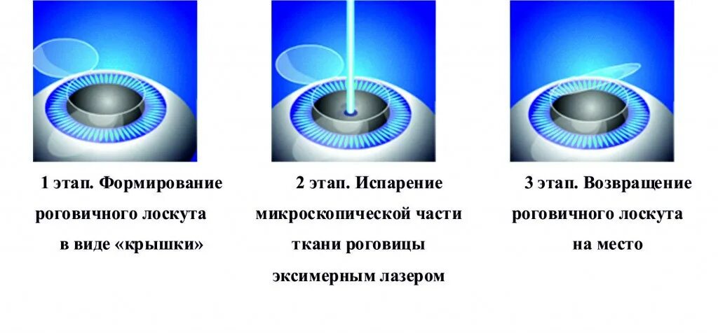 Коррекция зрения методом ласик. Лазерная коррекция зрения методом Femto-LASIK. Лазерная коррекция зрения принцип метода. Лазерный кератомилез in situ ласик. Коррекция зрения сравнение