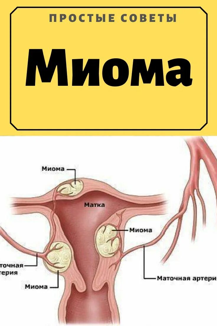 Миома от чего появляется матки у женщин