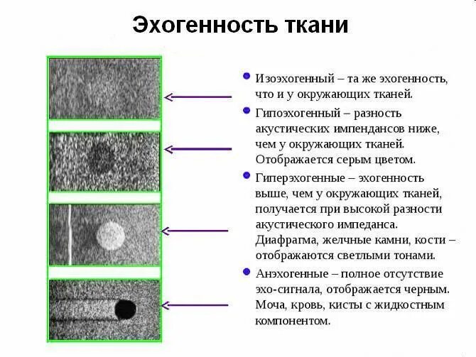 Образование без акустической тени. Эхогенность тканей. Виды эхогенности при УЗИ. Эхогенные структуры. Эхогенность структуры при УЗИ.