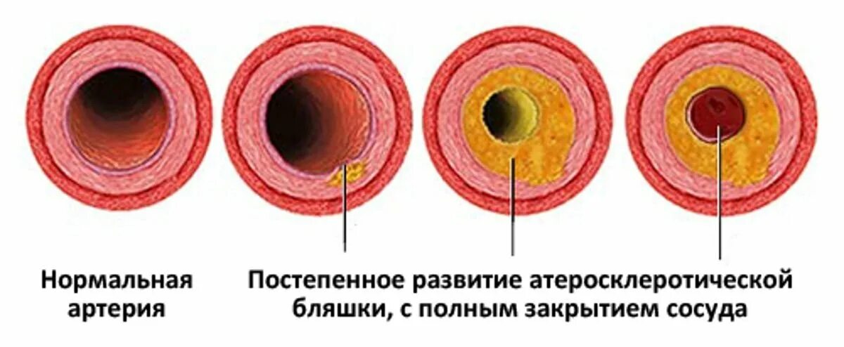 Холестериновые бляшки в сосудах. Нестенозирующий атеросклероз. Атеросклеротическая бляшка. Атерослеротическаябляшка.