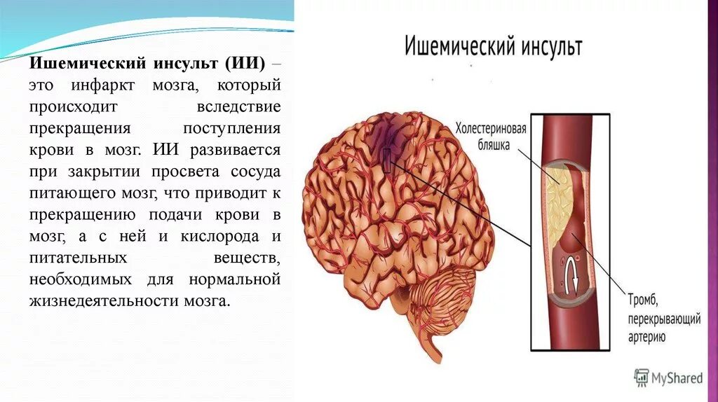 Что такое ишемический инсульт головного мозга. Ишемический инсульт головного мозга последствия. Ишемический инсульт поражения артерий. Ишемический инсульт (инфаркт мозга).