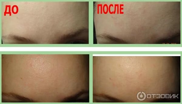 Кальция хлорид для лица пилинг. Скатка с хлористым кальцием. Хлористый кальций пилинг. Голливудский пилинг с хлористым кальцием. Кальция хлорид для лица пилинг.