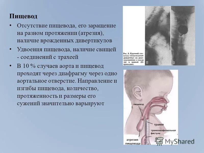 Пищеводе отсутствует судение. Операция Фоккера при атрезии пищевода. Формирование дивертикула пищевода на уровне аорты.