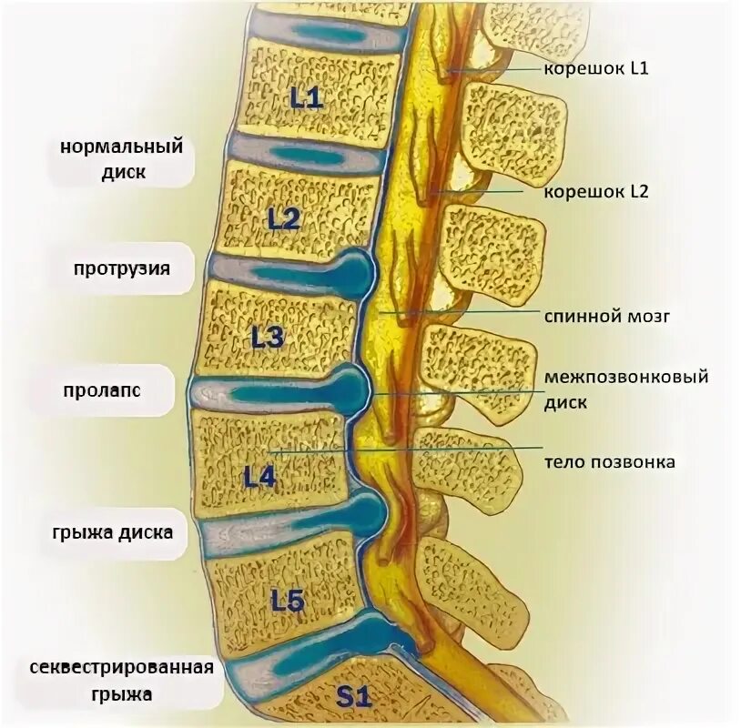 Межпозвонковые диски l5-s1. Протрузия l5 l6. Пролабирование дисков l1-s1. Пролабирование межпозвонковых дисков l3-l4.