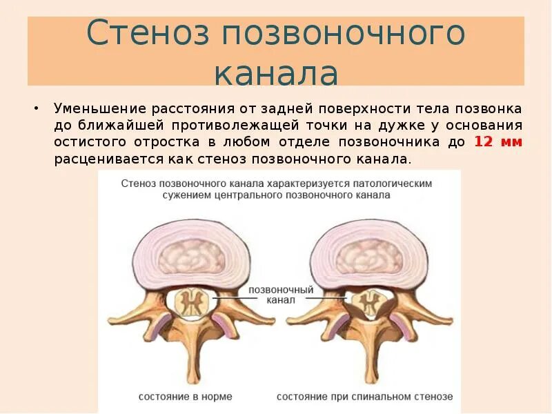 Медианно парамедианная билатеральная. Сужение спинномозгового канала l5s1. Стеноз костного позвоночного канала. Дегенеративный спинальный стеноз l3-l4. Стеноз межпозвонковых отверстий l2-s1.