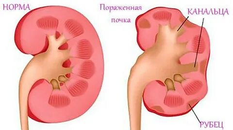 Можно греть почки грелкой