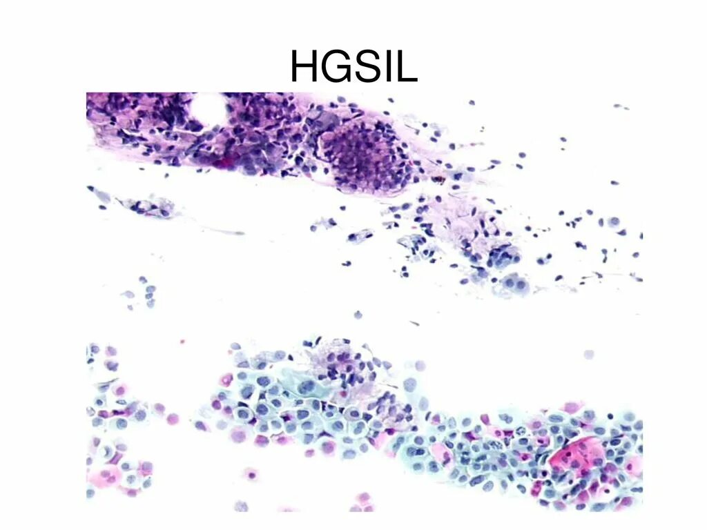 Интраэпителиальное поражение hsil. HSIL цитология расшифровка.