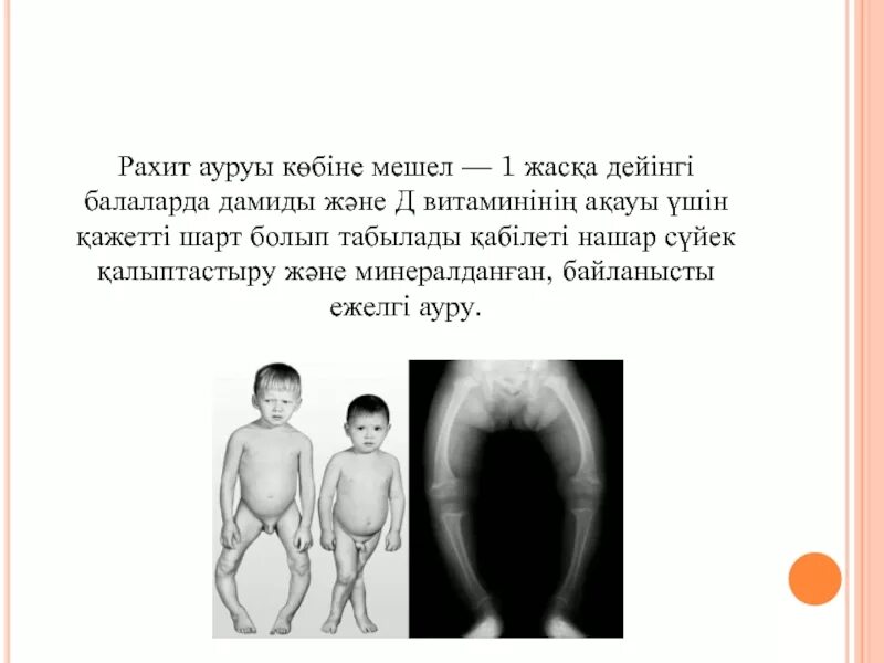 Питание больного рахитом