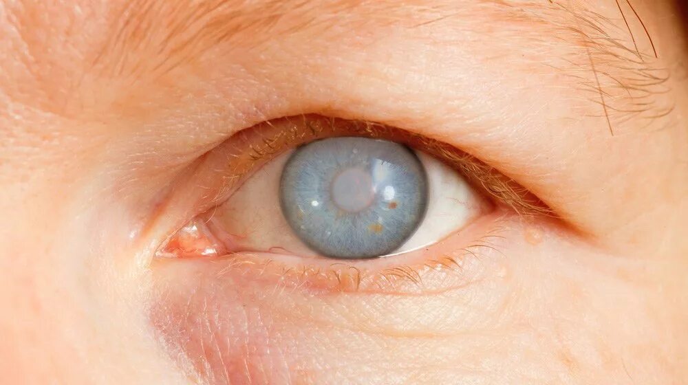 Глаза будто. Гемералопия (куриная слепота). Куриная слепота симптомы. Закрытоугольная глаукома глаза.