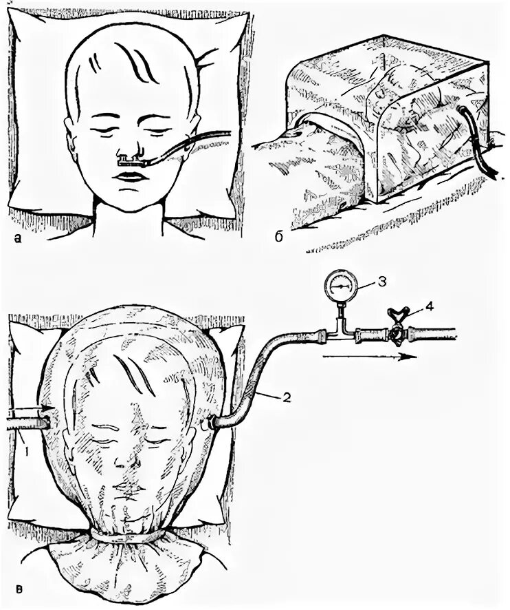 Алгоритм подачи кислорода через. Оксигенотерапия через носовой катетер ребенку. Носовой катетер для оксигенотерапии алгоритм. Носовой катетер для оксигенотерапии с аппаратом Боброва. Введение кислорода через носовой катетер.