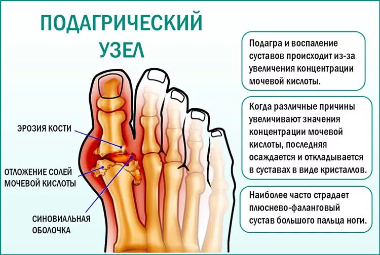 Мочевая кислота в крови какой врач. Подагра мочевая кислота.