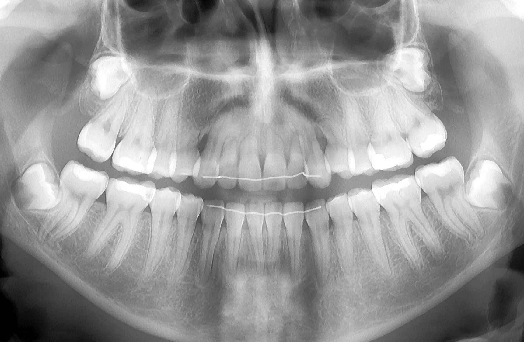 Ортопантомограмма челюсти. Сверхкомплектные зубы рентген. ОПТГ зубных рядов Пикассо.