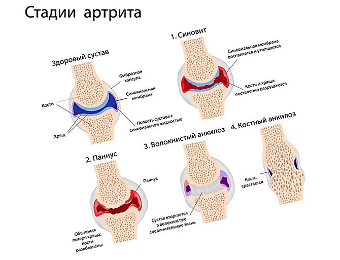 Первая стадия