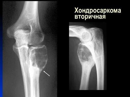 Хондросаркома