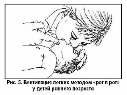 Сердечно легочная реанимация у детей до года