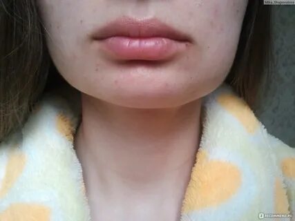 Сколько дней спадает отек после удаления зуба