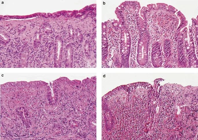 Биоптат кишки. Ретикулярная лимфома гистология. Мальт лимфома гистология. Субэпителиальный фиброз. Целиакия биопсия тонкой кишки.