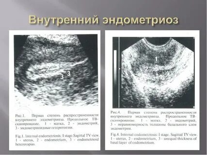 Узи при эндометриозе на какой день