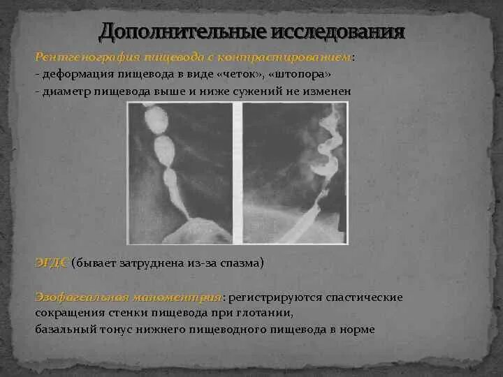 Диффузная пищевода. Штопорообразный пищевод рентген. Деформация пищевода в виде четок.