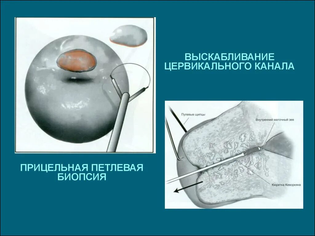 Ножевая биопсия. Выскабливание цервикального канала шейки. Эксцизионная биопсия шейки матки петлевая. Петлевая конизация шейки матки. Ножевая биопсия шейки матки с выскабливанием цервикального канала.