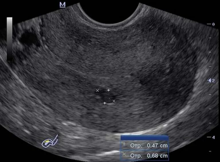Наботовы кисты на УЗИ шейки матки. Эндометриоидная киста шейки матки на УЗИ. Ретроцервикальный эндометриоз на УЗИ. Кист эндоцервикса что это такое у женщин