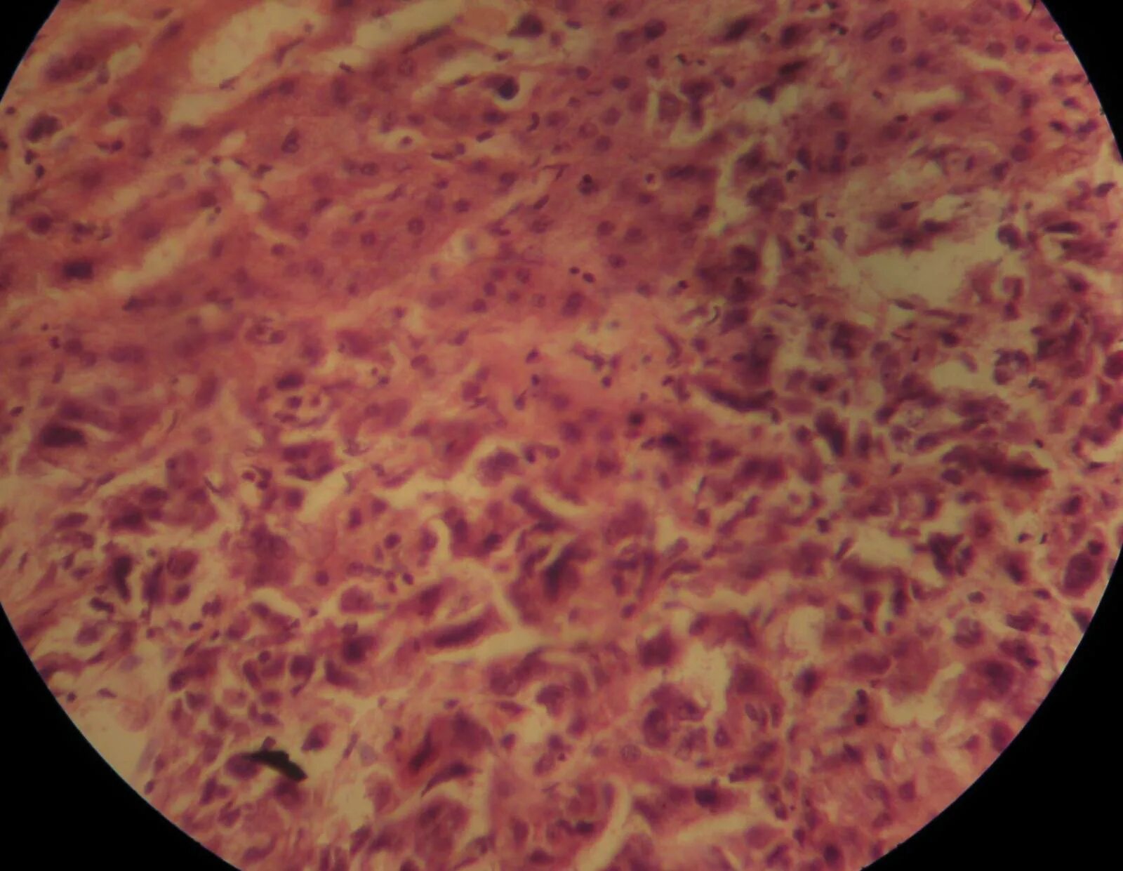 HEPATITIS DIABETICA - YouTube