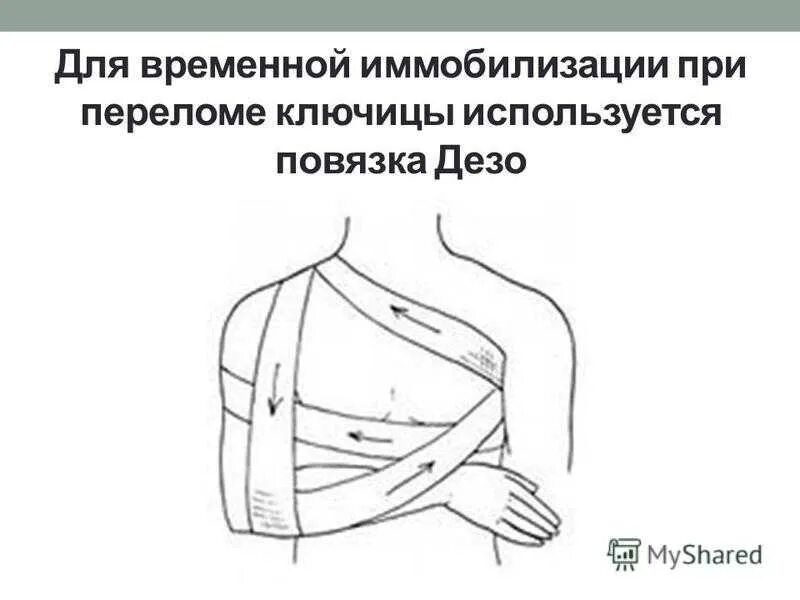 Оказание помощи при переломе ключицы. Транспортная иммобилизация при переломе ключицы дезо. иммобилизация конечности при переломе ключицы лопатки. повязка дезо косыночная повязка. шина при переломе ключицы транспортная.