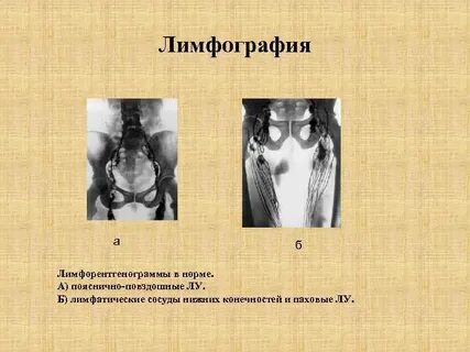 Лимфография