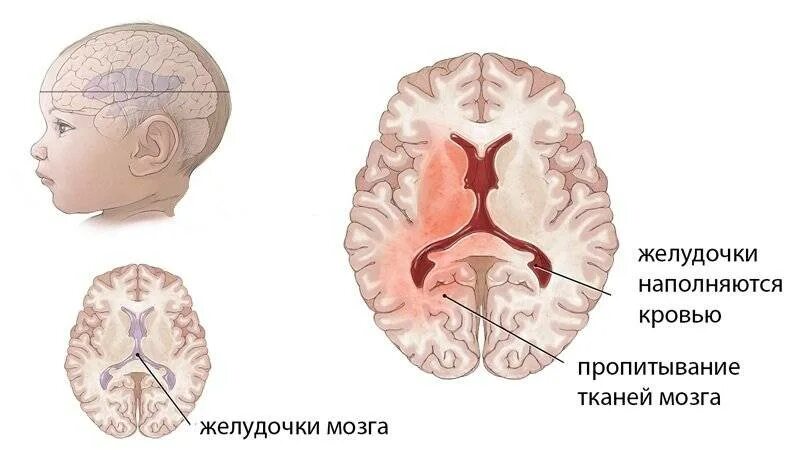 Интравентрикулярное кровоизлияние у новорожденных. Внутричерепные кровоизлияния у новорожденных. Внутрижелудочковое кровоизлияние 1 степени у новорожденных. Ишемия головного мозга 3 степени у новорожденных. Кровоизлияние в желудочки