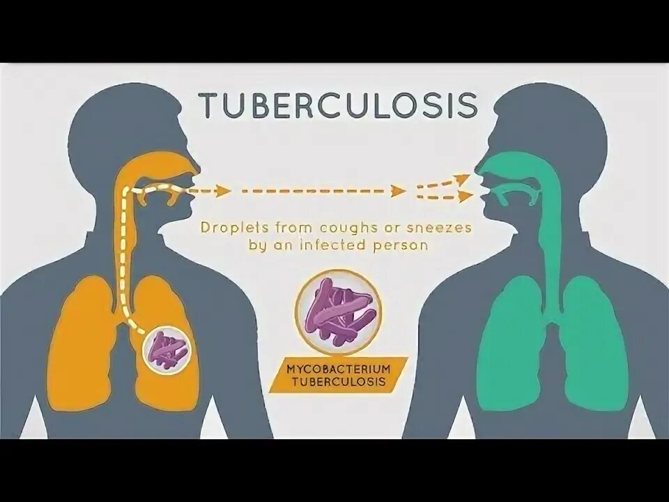 Туберкулез видеоролик