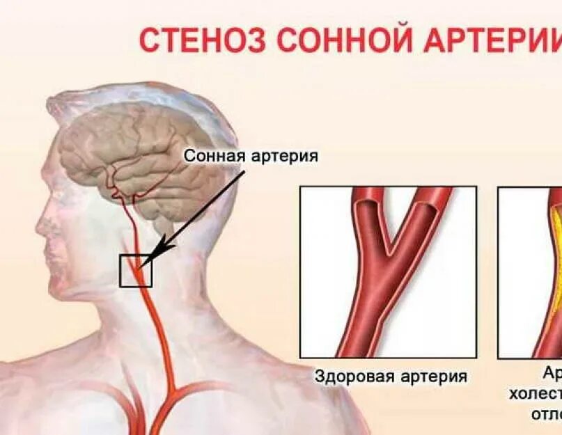 Сужение сонной артерии. Сужение сонных артерий шейного отдела 50%. Сужение сонной артерии на 20%. Стеноз сонной артерии симптомы.